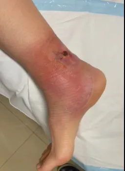 Buruli ulcer graphic Photo of a patient with a buruli ulcer