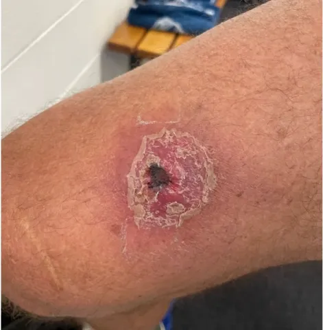 Buruli ulcer (graphic) Photo of a patient with a buruli ulcer on upper leg